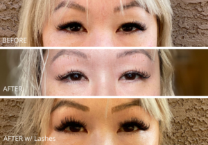 Eyelid fibroblast Before and After